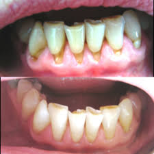 Drogen durch schlechte zähne Schlechte Zähne