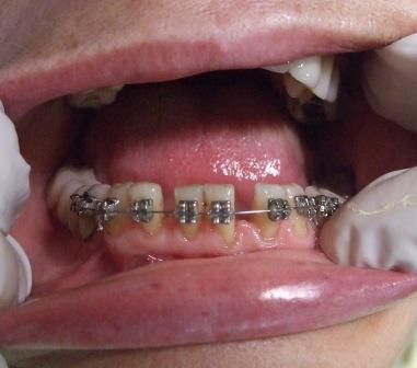 Posle parodontološke terapije, postavljen je ortodontski aparat.