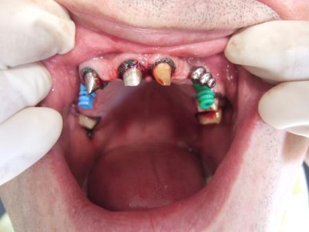 Pripremljeni i implantati i zubi za otisak