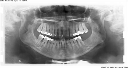 Početno stanje 2004. godina-terminalni stadijum parodontopatije.