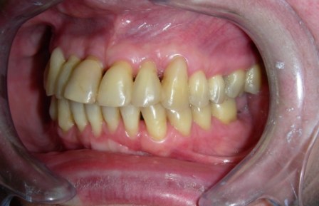 2010.godina – Pacijentkinja ima sve svoje zube. Stanje stabilno.